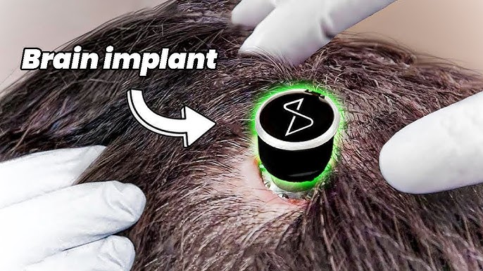 First Person with Elon Musk Neuralink Chip Speaks Out - YouTube