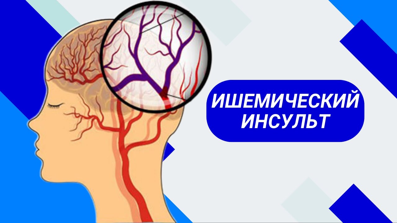 ИШЕМИЧЕСКИЙ ИНСУЛЬТ: ФАКТОРЫ РИСКА, СИМПТОМЫ И КАК ПРЕДОТВРАТИТЬ - YouTube