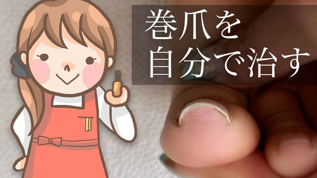 自分で巻爪を治す方法 アクリルを使ってみよう
