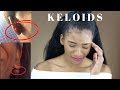 My Keloid Story *EXPLICIT* with Photos (How to get rid of them + What are they) | Annesha Adams