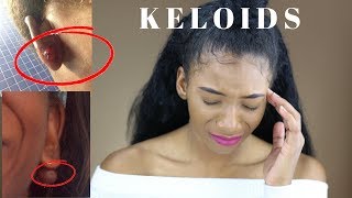 My Keloid Story *EXPLICIT* with Photos (How to get rid of them + What are they) | Annesha Adams screenshot 5