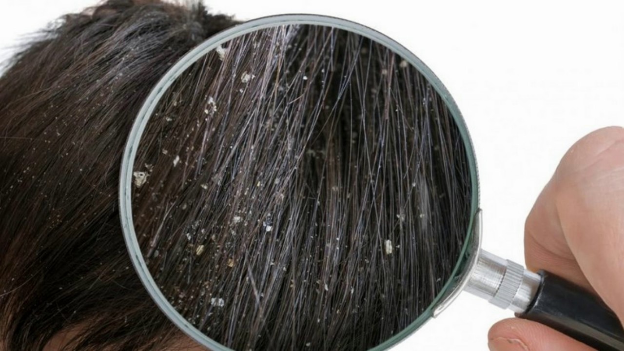 Difference Between Lice And Dandruff YouTube