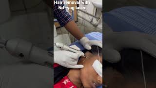 Hair removal with NDYAG LASER in a case of planned right ear reconstruction surgery shorts viral