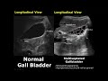 Gallbladder ultrasound normal vs abnormal image appearances comparison  gallbladder pathologies usg