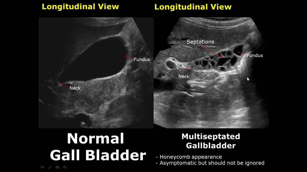gallbladder-ultrasound-normal-vs-abnormal-image-appearances-comparison