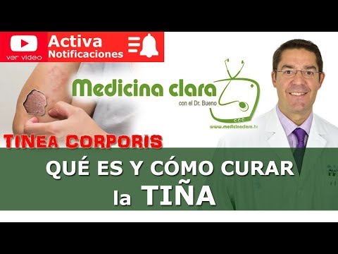 Video: 3 formas de tratar la tiña