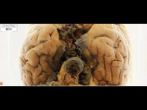 Brain - Ruptured berry aneurysm (Subarachnoid haemorrhage)