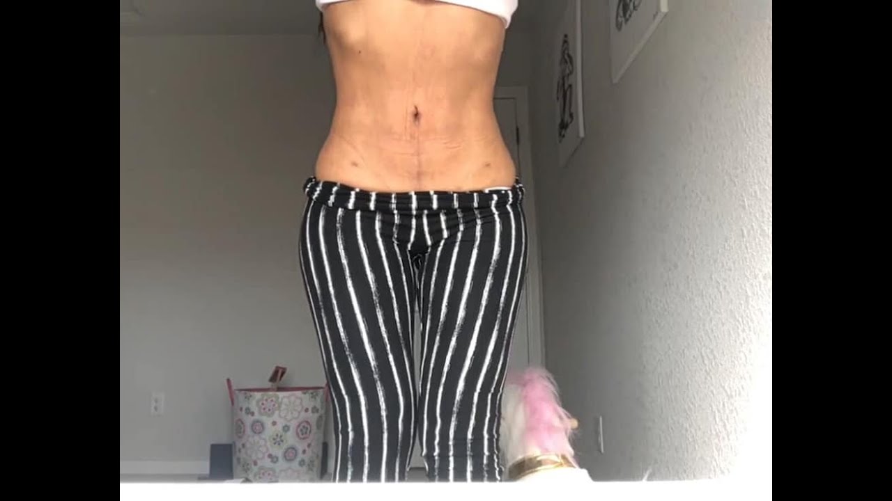 TIPS antes y despues cirugia de Liposuccion o BBL (TRASFERENCIA DE