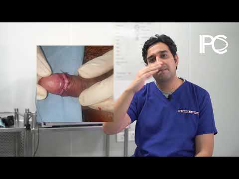 Video: Hoe Ziet Een Penis Eruit Na Besnijdenis?