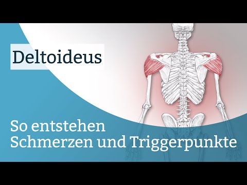 Deltoideus Schmerzen, Triggerpunkte und deren Aktivierung