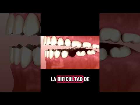 ⚠️ Las graves consecuencias por la pérdida de un diente ⚠️