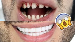 DO I REGRET GETTING VENEERS? Q&A 6 months update (Dental Centre Turkey)