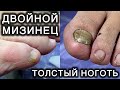 ОНИХОГРИФОЗ 17-ТИ ЛЕТНЕЙ ДАВНОСТИ! ЧТО С ЭТИМ ДЕЛАТЬ? #аленалаврентьева #подолог #подология #ногти