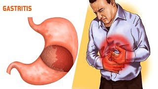 How to Get Rid of the Gastritis Naturally at Home