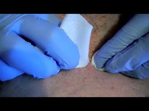 Sebaceous cyst draining - YouTube