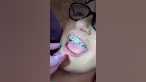 How to Floss With Braces
