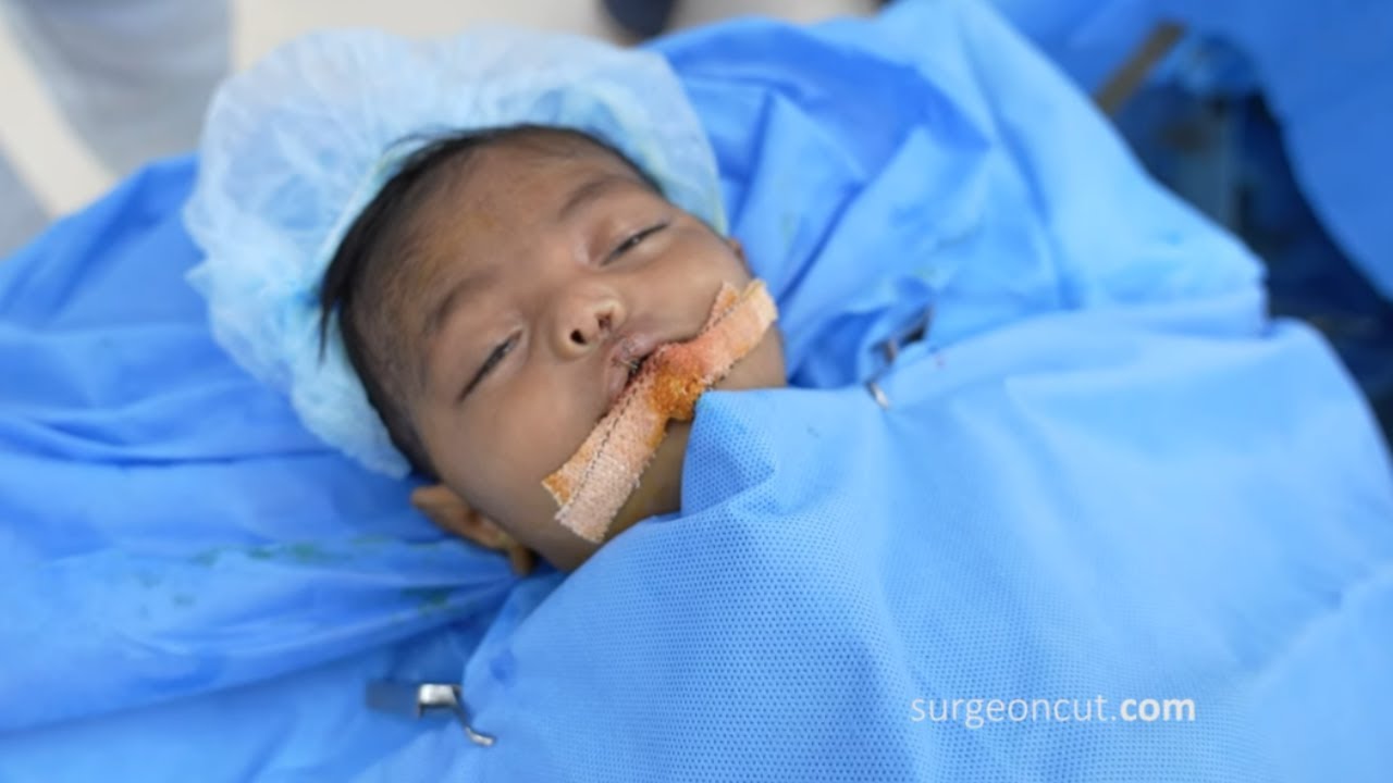 3 Months Old Baby had a Wide Cleft Lip & Palate Surgery in India Full