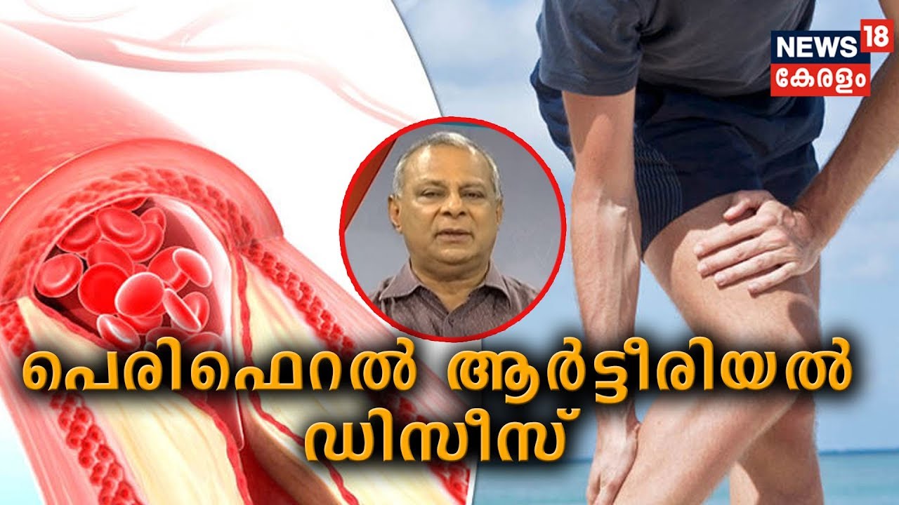 Dr Q : പെരിഫെറല്‍ ആര്‍ട്ടീരിയല്‍ ഡിസീസ്‌ | Peripheral Arterial Disease  | 21st August 2019
