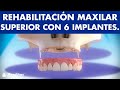 Dentadura fija - Rehabilitación del maxilar con 6 implantes ©