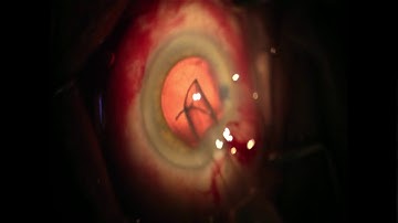 How to inject an MA60 intraocular lens into the eye