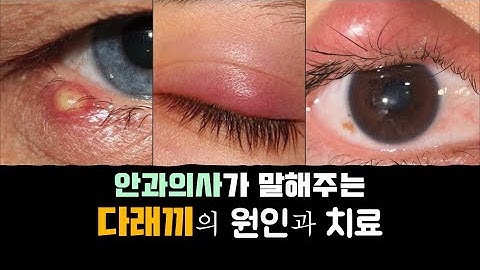 다래끼 빨리 낫는 법?  다래끼의 원인과 치료를 알아보겠습니다.