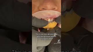 Minimal prep temporary veneers! You don’t have to ruin your teeth for a new smile!