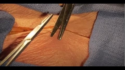 Basic Skills Sutures and Knot Tying: Subcuticular Running Suture