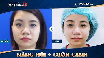 Nâng mũi Sline 3D kết hợp cuộn cánh mũi