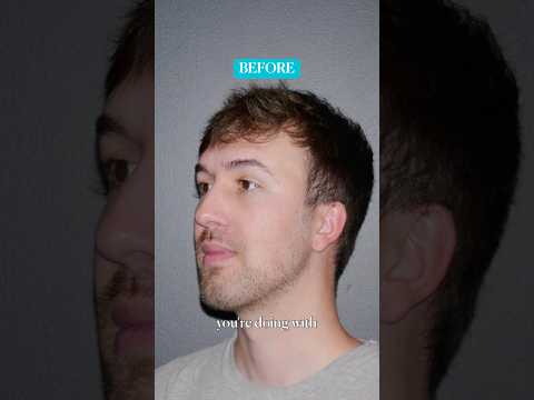 Video thumbnail: Two Procedures, Zero Regrets 👃 Rhinoplasty + Chin Implant Results #rhinoplasty #chinimplant · Dr. Manish H. Shah