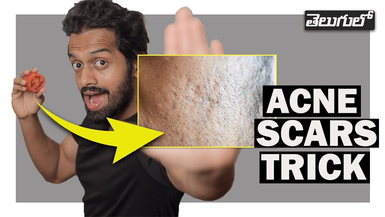 How To Remove ACNE SCARS PERMANENTLY (7 natural remedies) YouTube