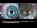 Perfect lasik  standard operating procedure professor reinstein and fellow sidebyside comparison