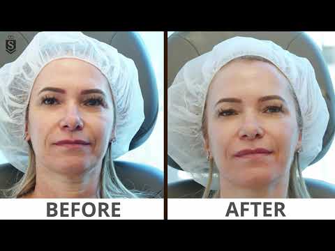 V2 Microneedling V2 Beauty Booster Treatment Sovereignskin Youtube