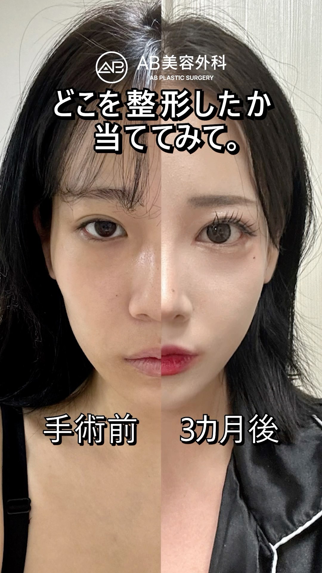 どこを整形したか当ててみて！#shorts