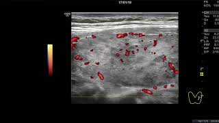 Клинический случай 3. (УЗИ Щитовидной Железы ) доктор А.В. Ушаков