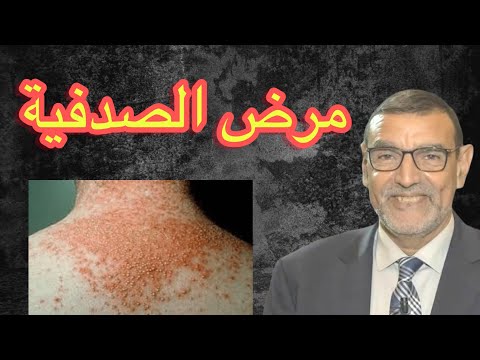 الدكتور محمد فائد مرض الصدفية