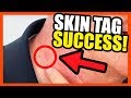 Auto TagBand Follow Up- Skin Tag Success!