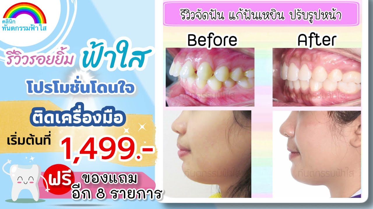 รวมรีวิวเคสจัดฟัน l ทันตกรรมฟ้าใส l จัดฟันระยอง
