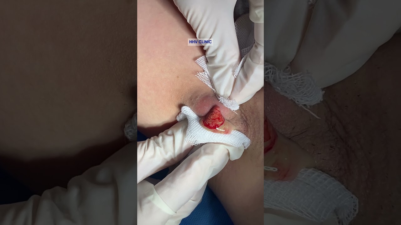 Nhọt ở nách sưng viêm mủ trắng, nhìn thôi cũng thấy đau rồi.
