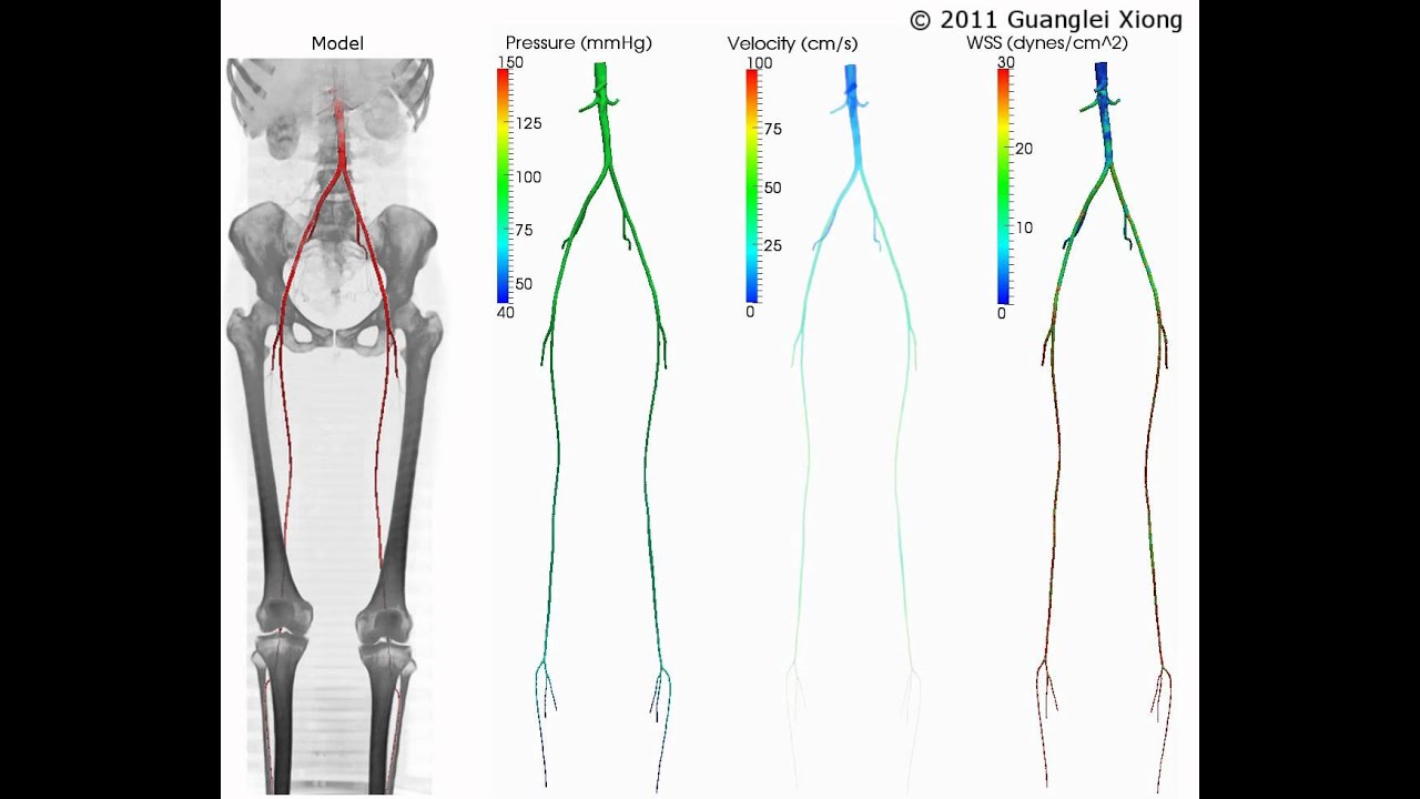 Simulation of blood flow in aorto-femoral arteries - YouTube