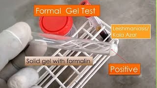 Aldehyde test| Formal gel test positive| Chopra aldehyde test|Visceral Leishmaniasis| Kalazar