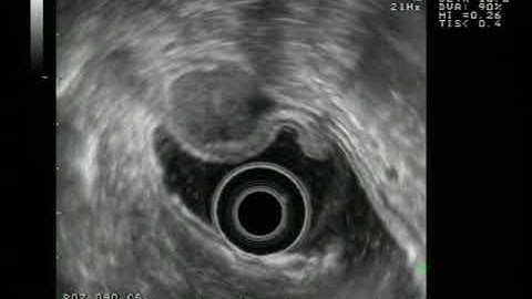 Stomach malignant GIST