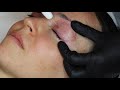 Fibroblast Blaze Needling - Upper Eye