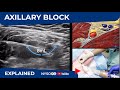 Ultrasound Guided Axillary Brachial Plexus Block NYSORA Regional Anesthesia