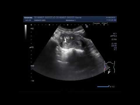 Video: Kan du se implantasjon på ultralyd?
