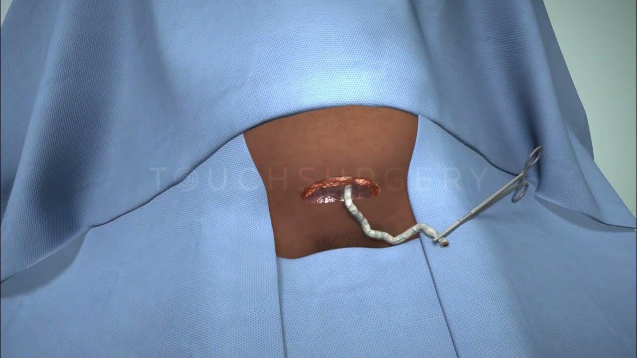 touch-surgery-simulation-cesarean-section-patient-information-video