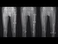 Leg length discrepancy- what you should know