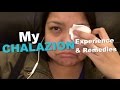 My Chalazion Experience & Remedies