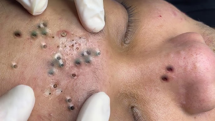 Blackheads & Acne Treatment 24.05.2024 (Part 1) #blackhead #whitehead #acne  #blackheadremoval - YouTube