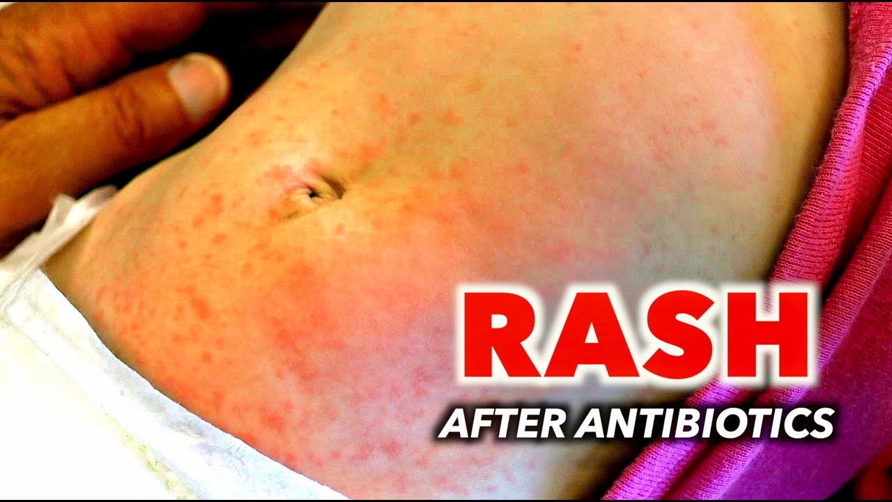 Rash After Antibiotics Is This An Allergic Reaction Dr Youtube