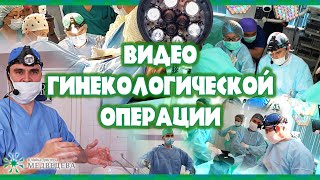 Офисная гистероскопия большой субмукозный узел